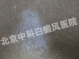 白癜风医院